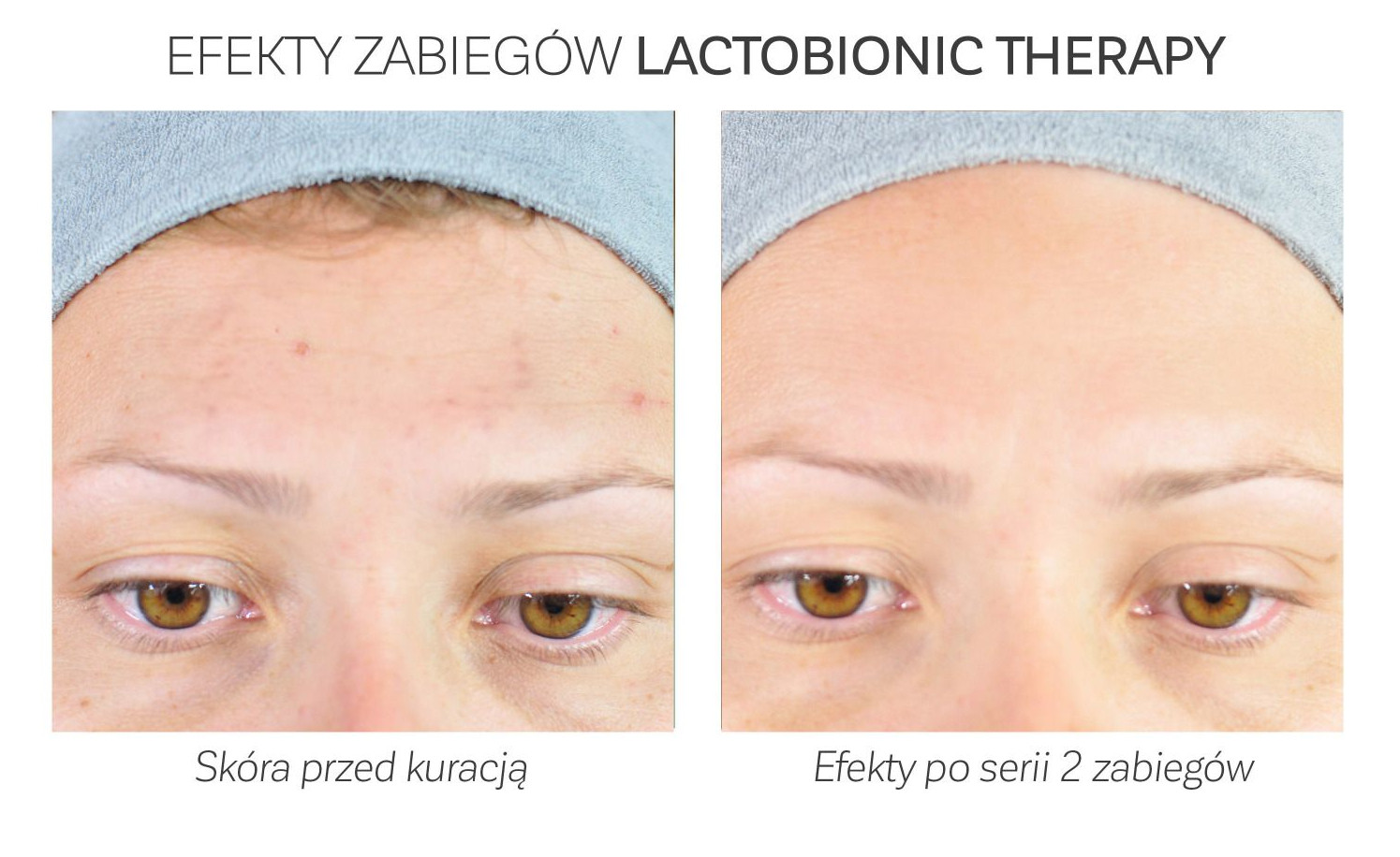 Lactobionic therapy