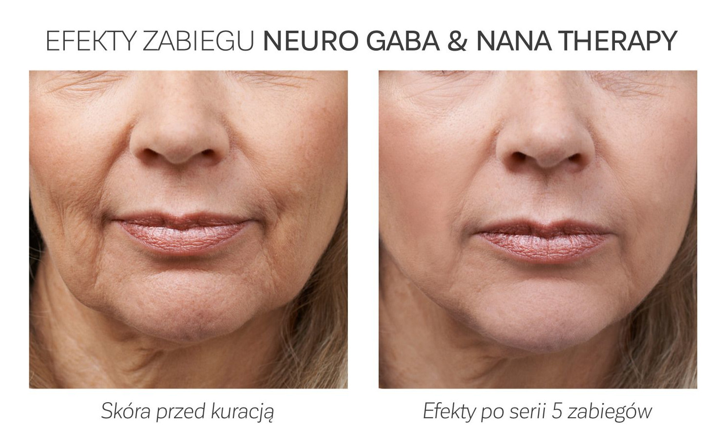 Neuro Gaba Nana Therapy efekty zabiegu